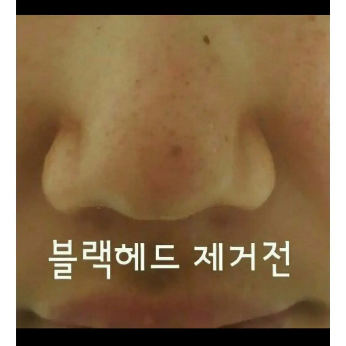 모공분말 블랙헤드,화이트헤드 제거 에스테틱제품