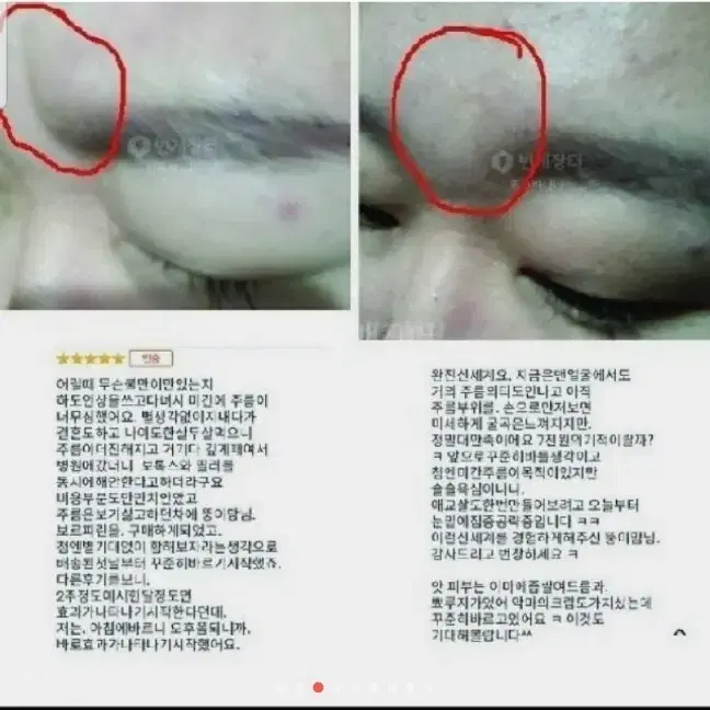 볼륨 이마 주름 콧대 볼꺼짐 눈밑애교살 보르피린앰플 화장품메디필