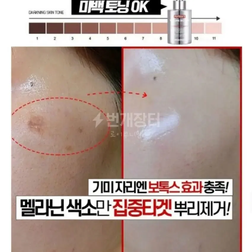 기미보톡스 멜라닌 색소침착 보르톡스 보르피린 주름 잡티 광택 주근깨 기미