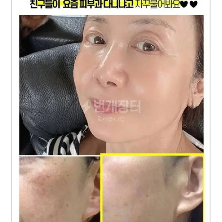 기미보톡스 멜라닌 색소침착 보르톡스 보르피린 주름 잡티 광택 주근깨 기미