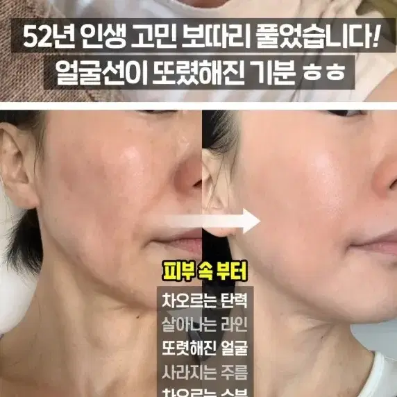 이유리 리프팅 톡스 미친 볼륨 콜라겐실리프팅 주름 모공 탄력광채 메디필