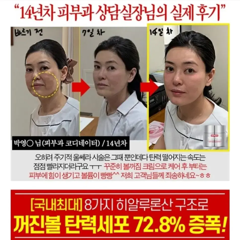 볼꺼짐 리프팅 필러 탄력 물광 보르피린 보톡스 주름개선 아이크림 팔자주름