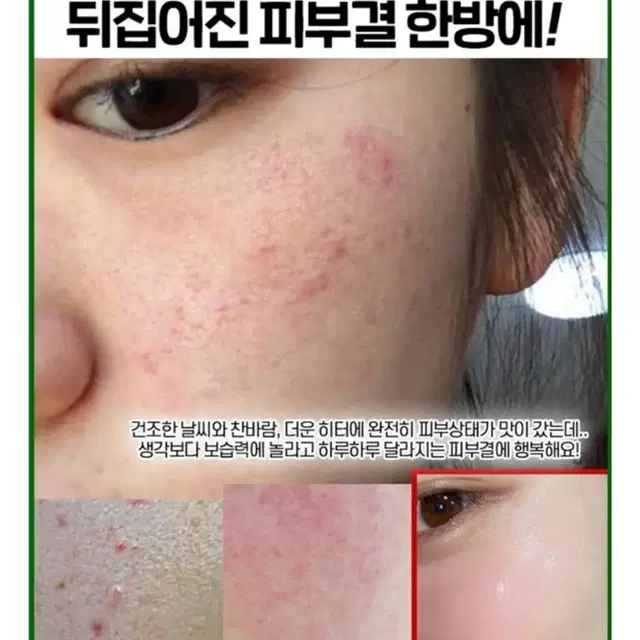 새상품 비립종 좁쌀 피지제거 각질제거 트러블앰플 여드름크림 예민피부