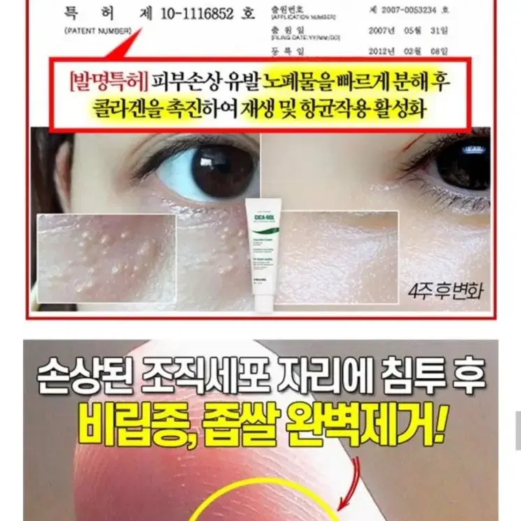 새상품 비립종 좁쌀 피지제거 각질제거 트러블앰플 여드름크림 예민피부