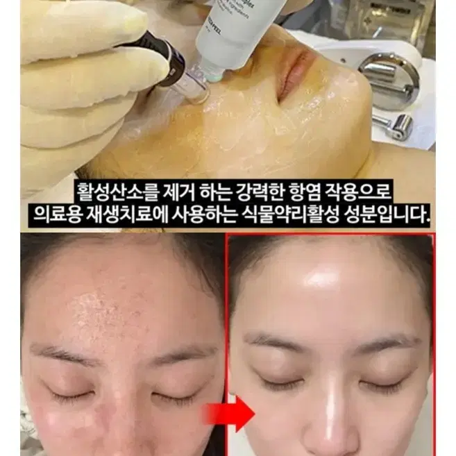 새상품 비립종 좁쌀 피지제거 각질제거 트러블앰플 여드름크림 예민피부