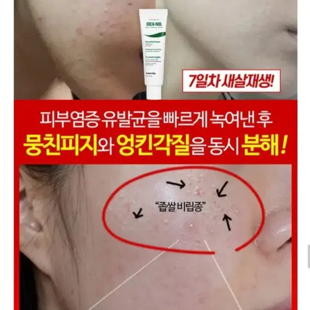 새상품 비립종 좁쌀 피지제거 각질제거 트러블앰플 여드름크림 예민피부