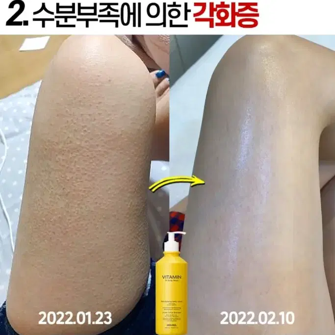 겨드랑이 색소침착 검버섯 닭살 전신미백 화장품 향수바디워시 미백비누메디필