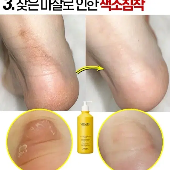 겨드랑이 색소침착 검버섯 닭살 전신미백 화장품 향수바디워시 미백비누메디필