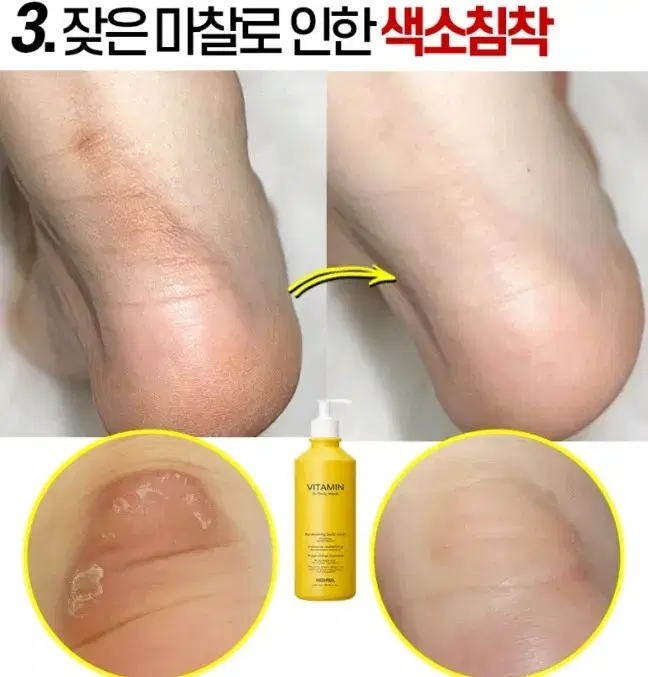 겨드랑이 색소침착 검버섯 닭살 전신미백 화장품 향수바디워시 미백비누메디필