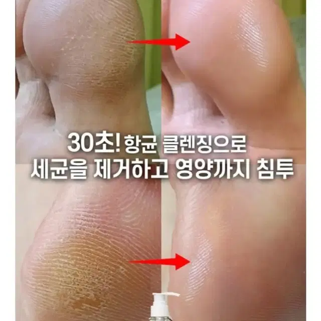 풋케어 무좀 곰팡이균 발각질 세균 간지러움 무좀원인 완벽제거 젤네일