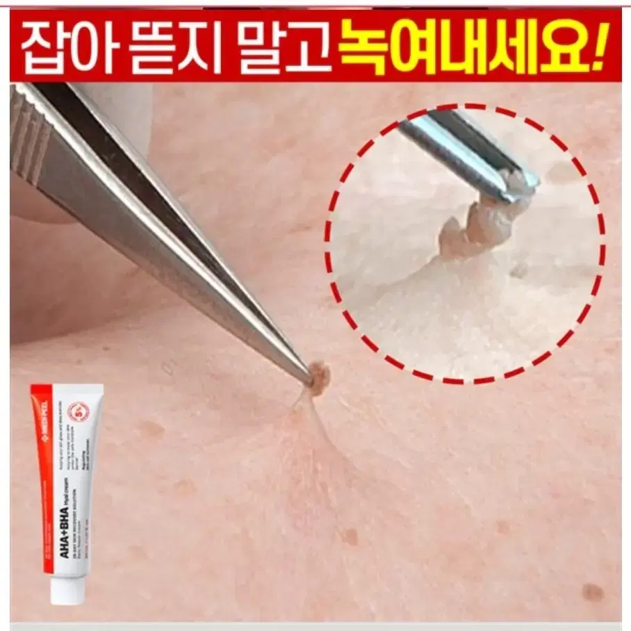 비립종 쥐젖 만능스팟 제거 편평사마귀 한관종 저자극 크림