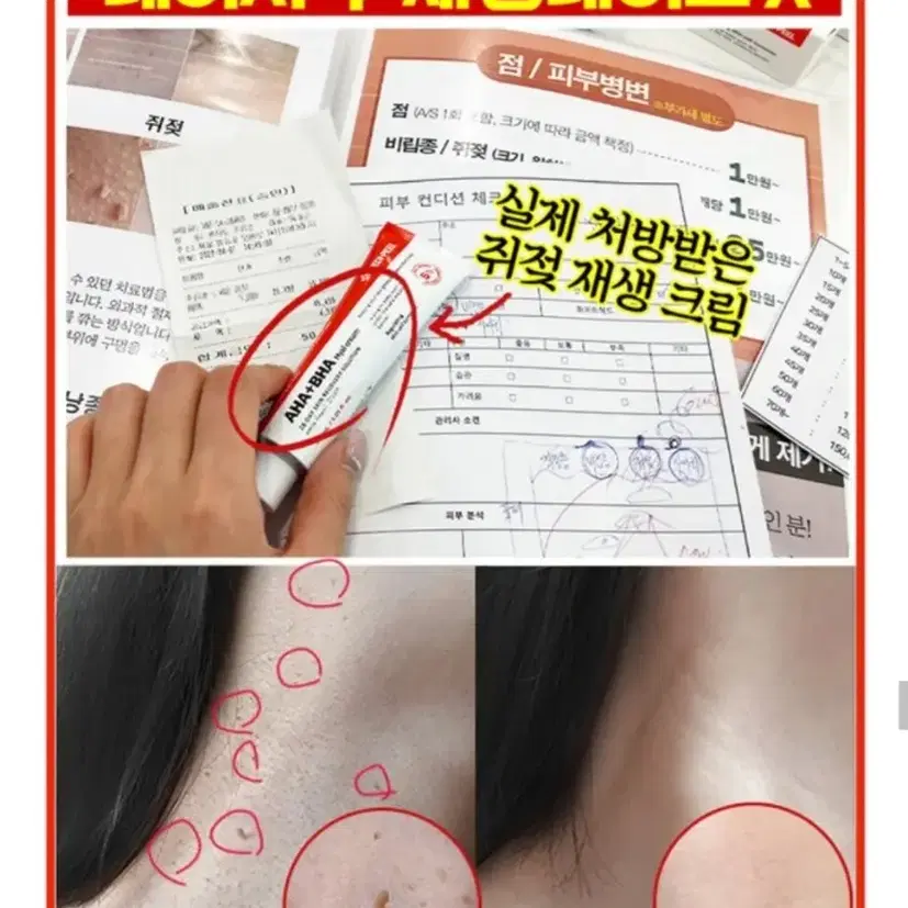 비립종 쥐젖 만능스팟 제거 편평사마귀 한관종 저자극 크림