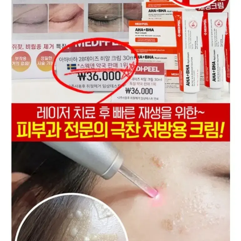 비립종 쥐젖 만능스팟 제거 편평사마귀 한관종 저자극 크림