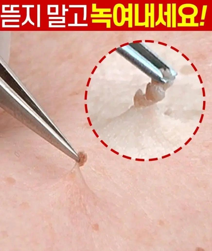 아하바하 승무원 녹이는 쥐젓크림 사마귀 쥐젓 비립종 화장품 에센스 네일