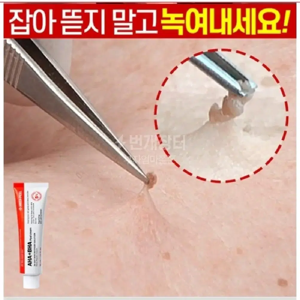 비립종 쥐젖 만능스팟 제거 편평사마귀 한관종