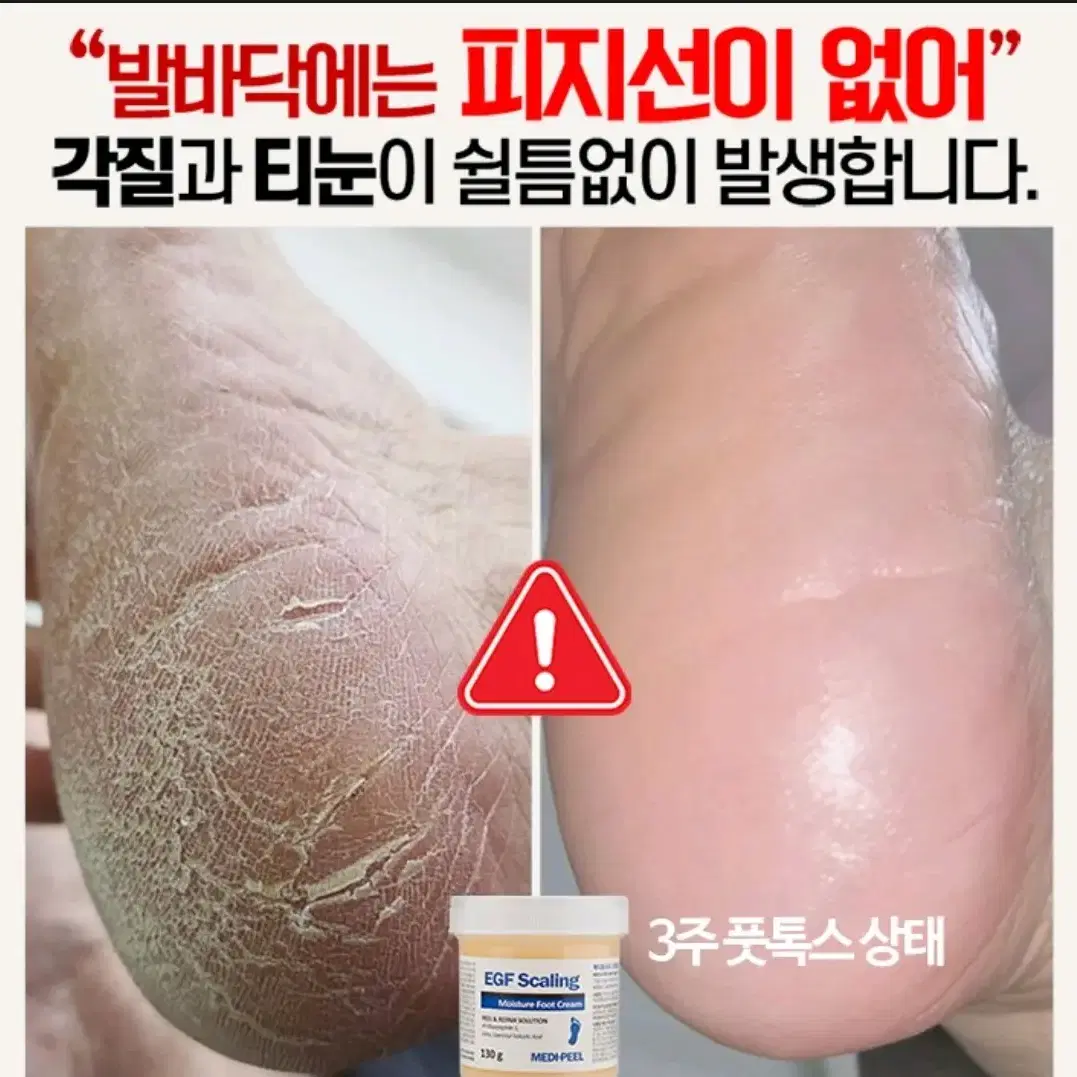 메디필 EGF 스케이링 모이스처 풋크림 티눈크림 굳은살 각질 티눈 화장품