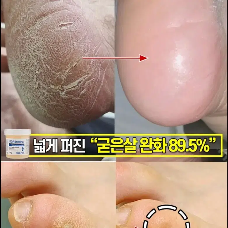 메디필 EGF 스케이링 모이스처 풋크림 티눈크림 굳은살 각질 티눈 화장품