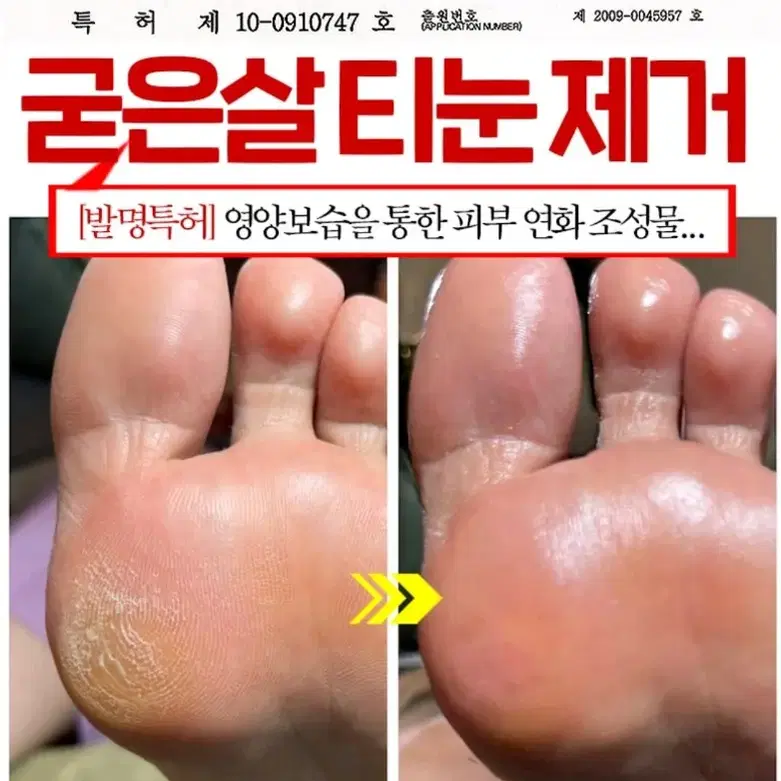 메디필 EGF 스케이링 모이스처 풋크림 티눈크림 굳은살 각질 티눈 화장품