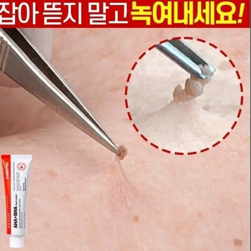 아하바하 승무원 녹이는 쥐젓크림 사마귀 쥐젓 비립종 화장품 에센스 메디필