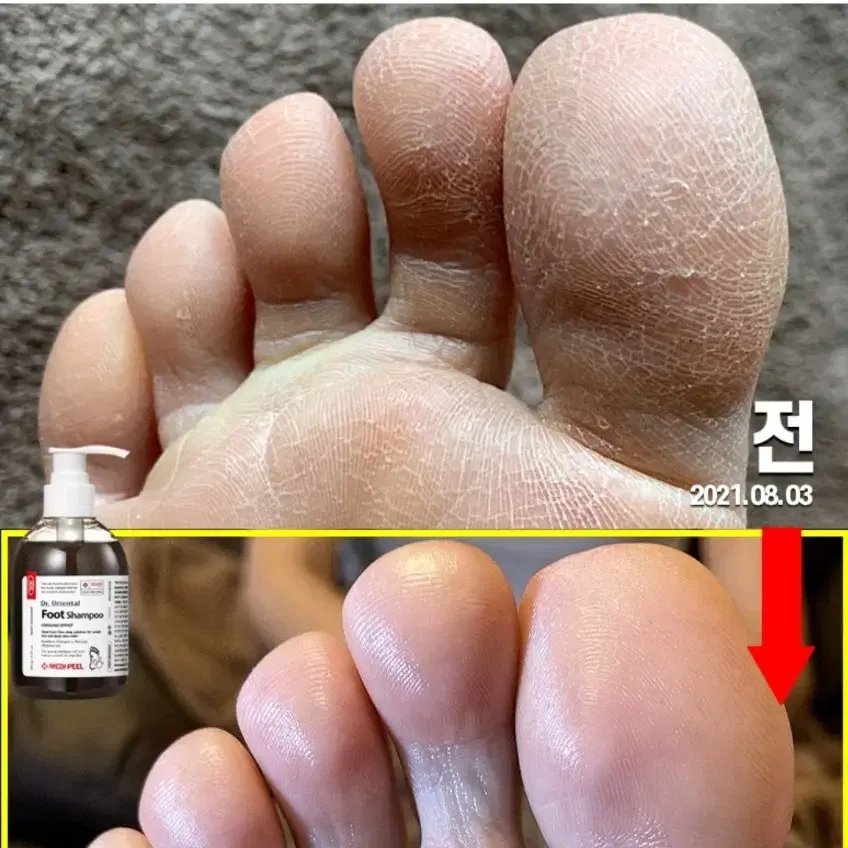 아기발 발냄새 발습진 각질 무좀 보습 한방 목초액 풋 샴푸 화장품 메디필