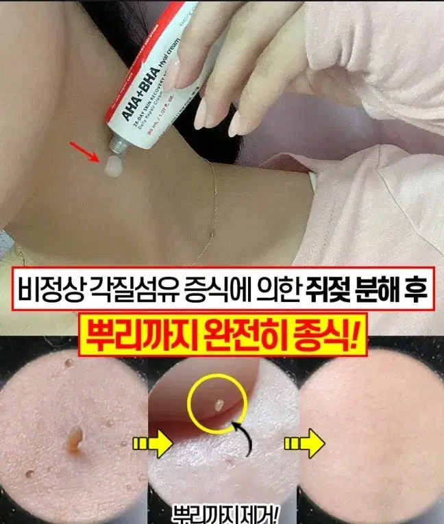 메디필 아하바하 히알크림 승무원 녹이는 쥐젓크림 사마귀  비립종 화장품