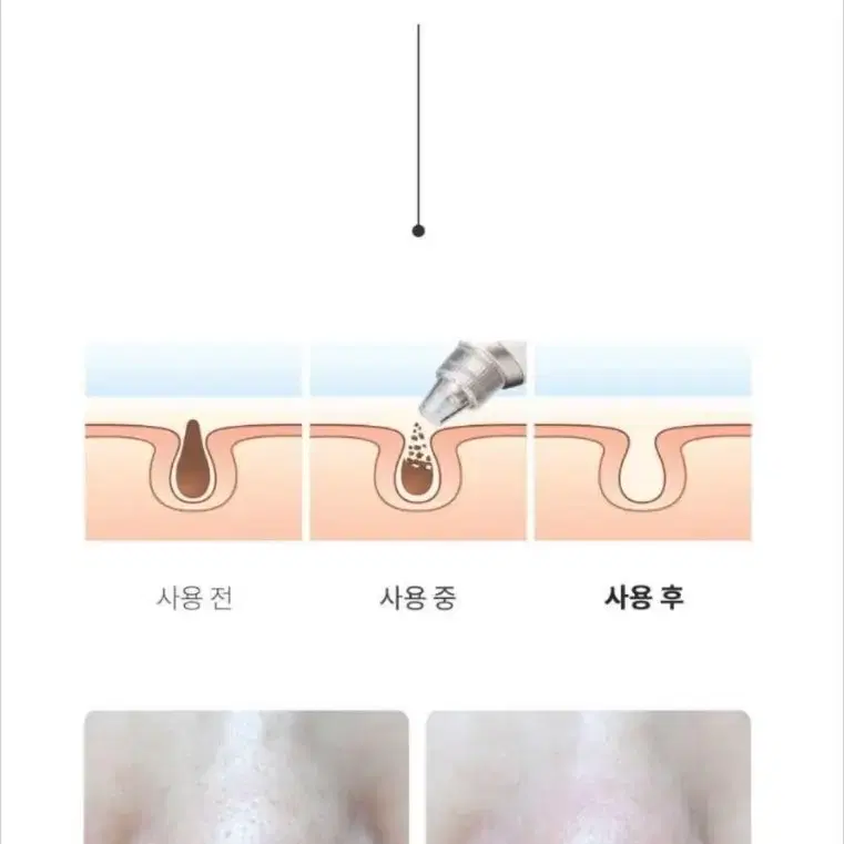 뷰티석션 피지흡입기