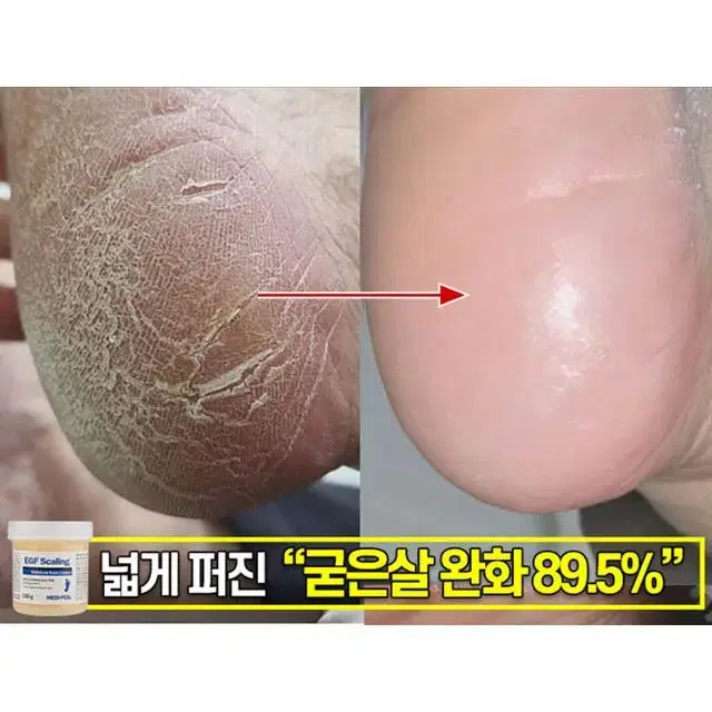 메디필 EGF 풋크림 각질 티눈 굳은살 제거 (면도기+솜털제모기 사은품)