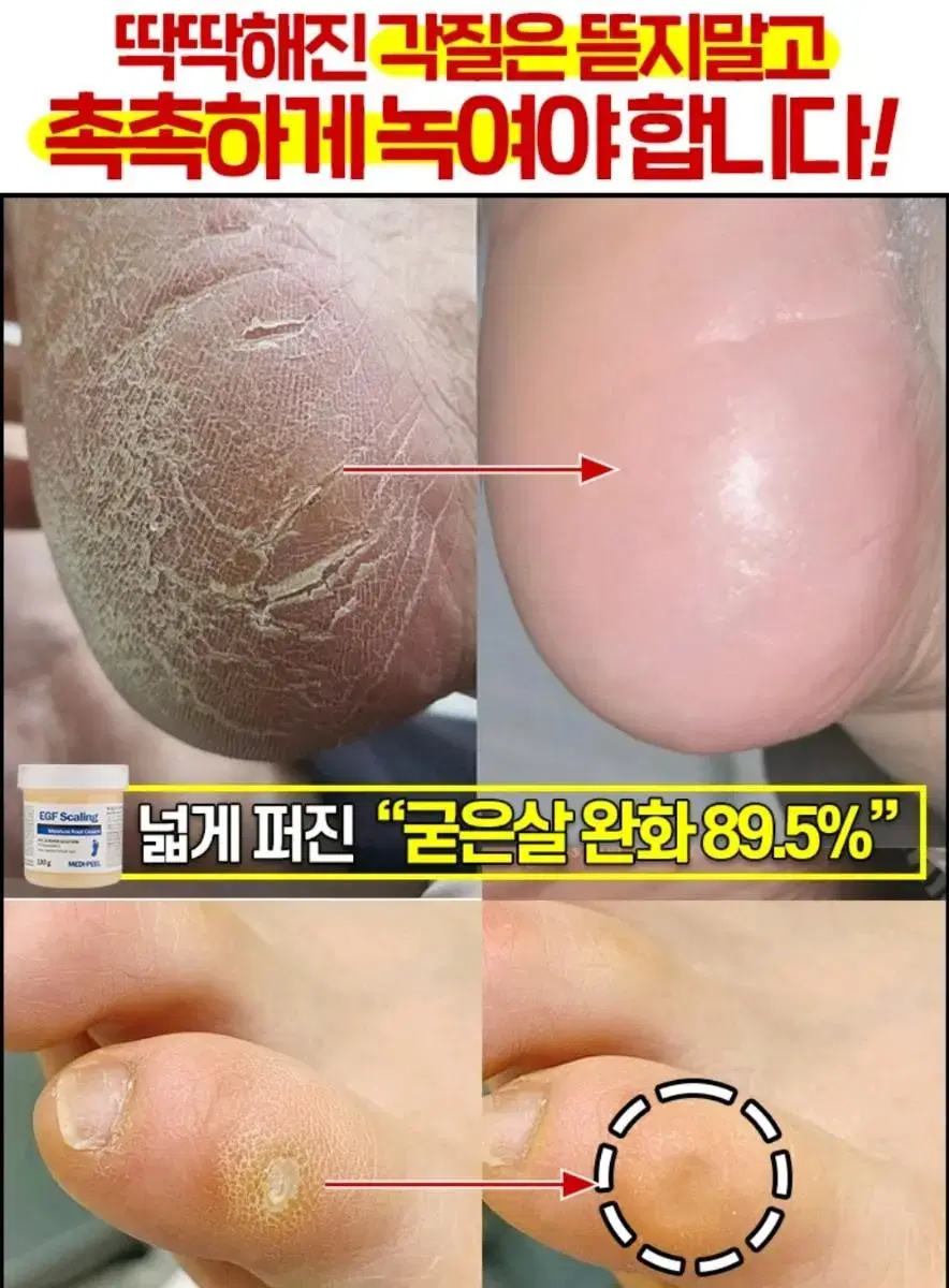 메디필 풋크림 아기발완성 각질 굳은살 발각질연화 촉촉한 발 관리