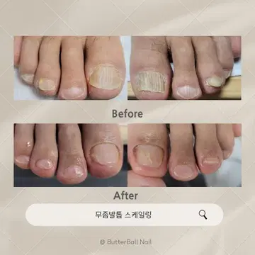 내성발톱 모델구해요~~ | 브랜드 중고거래 플랫폼, 번개장터 내성발톱 모델구해요~~ | 브랜드 중고거래 플랫폼, 번개장터