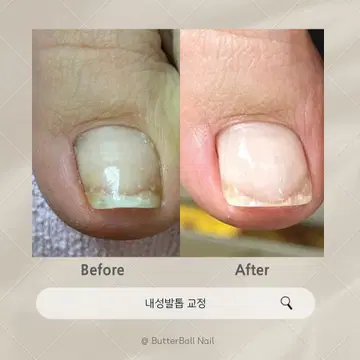 내성발톱 모델구해요~~ | 브랜드 중고거래 플랫폼, 번개장터 내성발톱 모델구해요~~ | 브랜드 중고거래 플랫폼, 번개장터