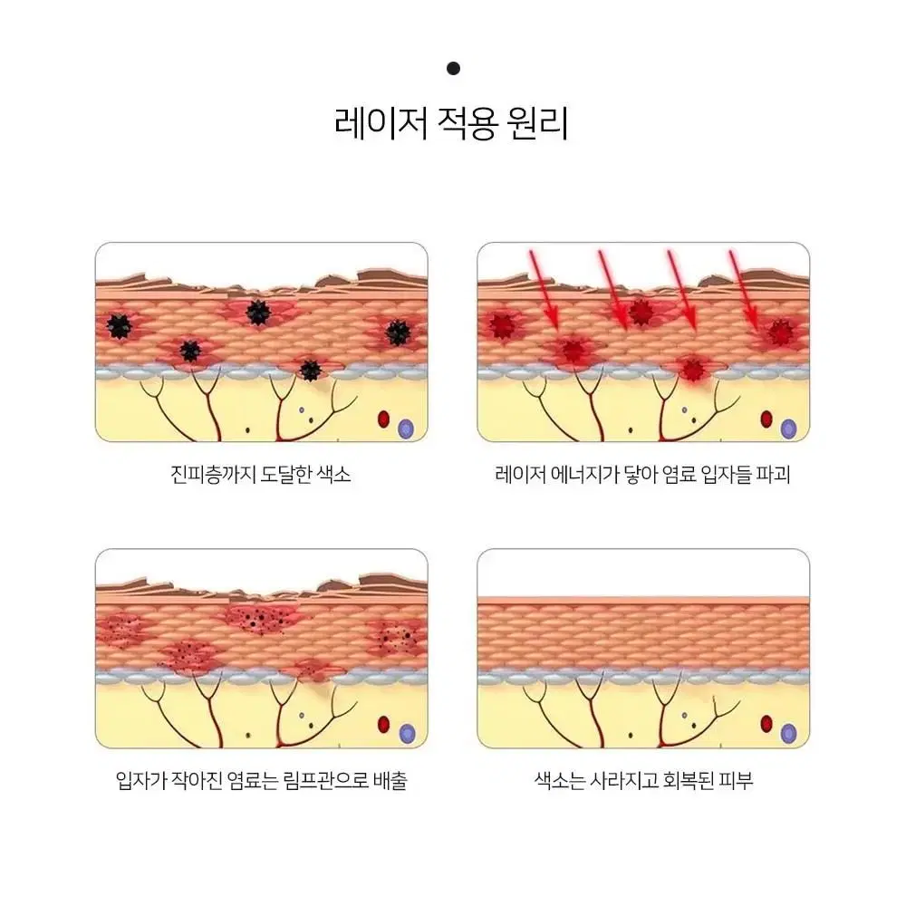 피코 레이저 1064nm렌즈 532nm렌즈 토닝렌즈 소프트렌즈 주근깨 잡