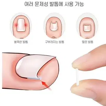 내향성 내성 발톱 교정 관리 커브 스틱 10P | 브랜드 중고거래 플랫폼, 번개장터