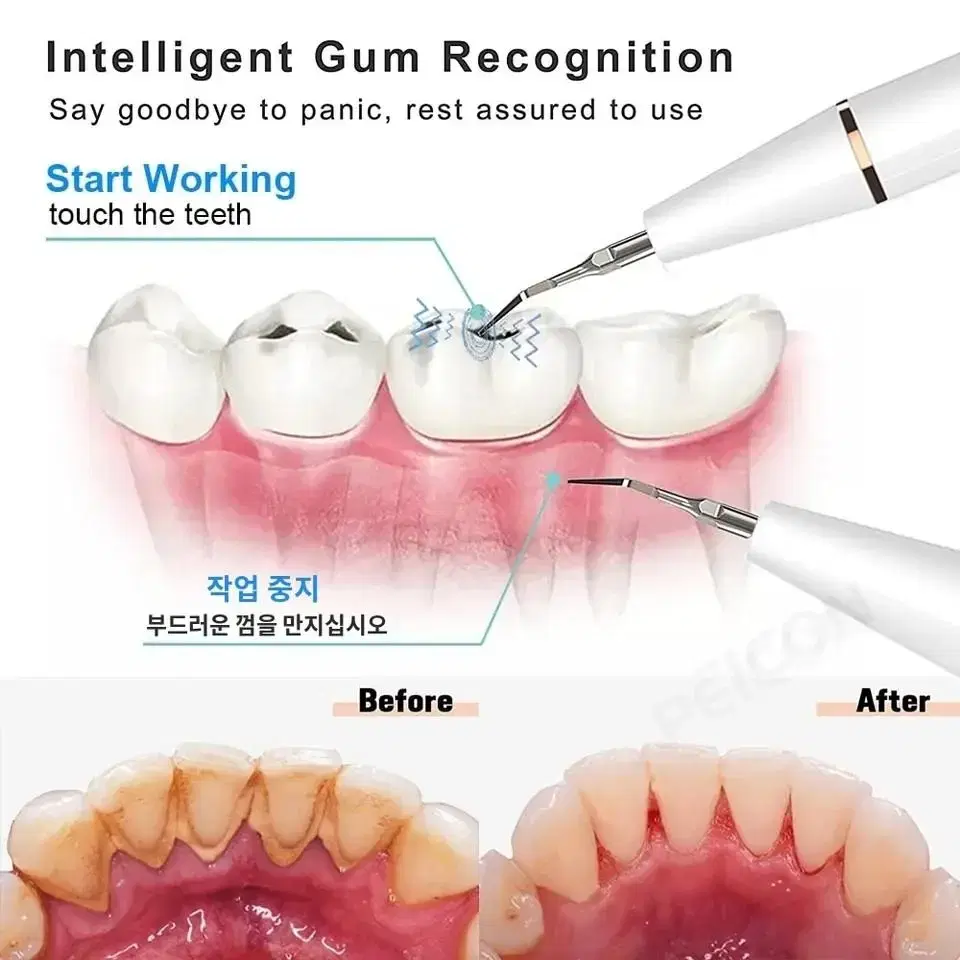 치아 관리 치석 제거 하얀 이빨 관리