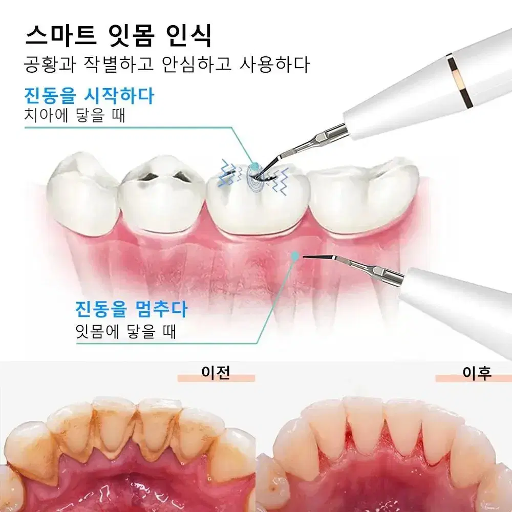 치아 관리 치석 제거 하얀 이빨 관리