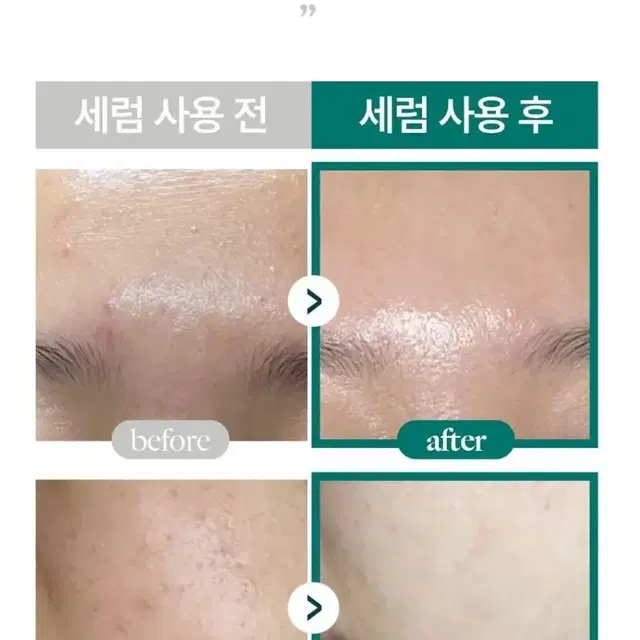 일주일만 발라도 달라 쁘띠라 글로우 히알루로닉 MTS 미백 주름 수분세럼