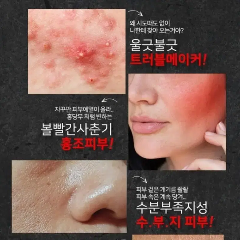 홍조.여드름.민감한피부,아토피,지루성,수부지 민감한피부 는꼭써보세요