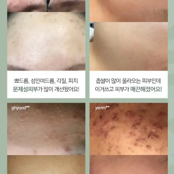 홍조.여드름.민감한피부,아토피,지루성,수부지 민감한피부 는꼭써보세요