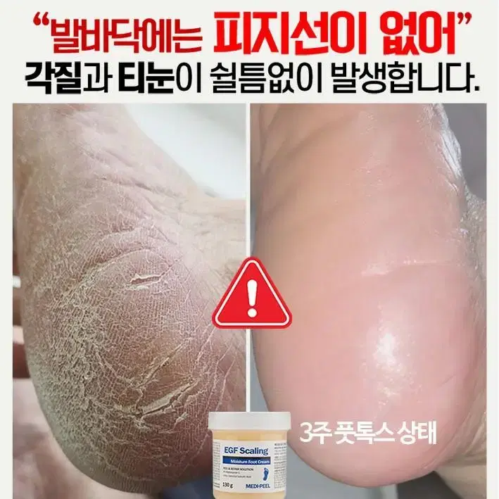 메디필 티눈크림  보들발 허니 풋톡스