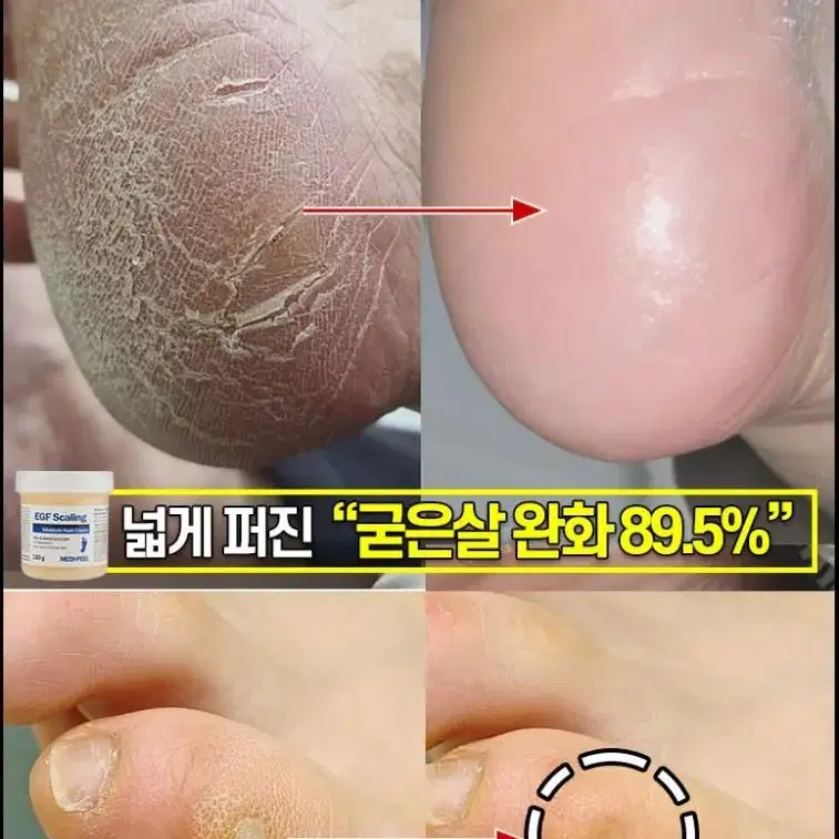 메디필 티눈크림  보들발 허니 풋톡스