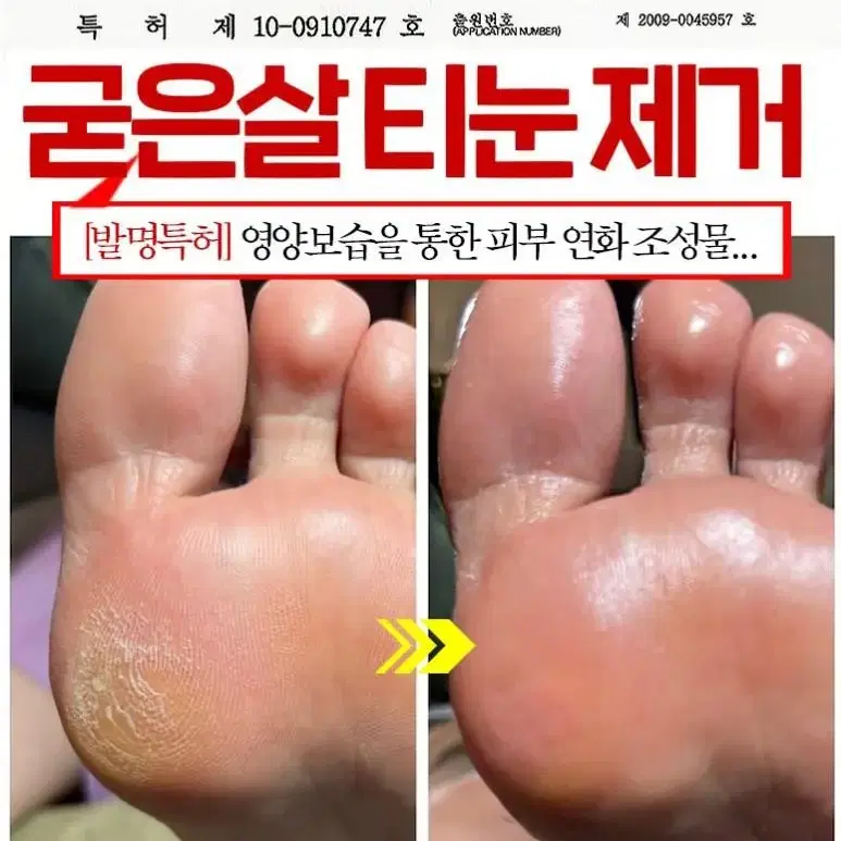 메디필 티눈크림  보들발 허니 풋톡스