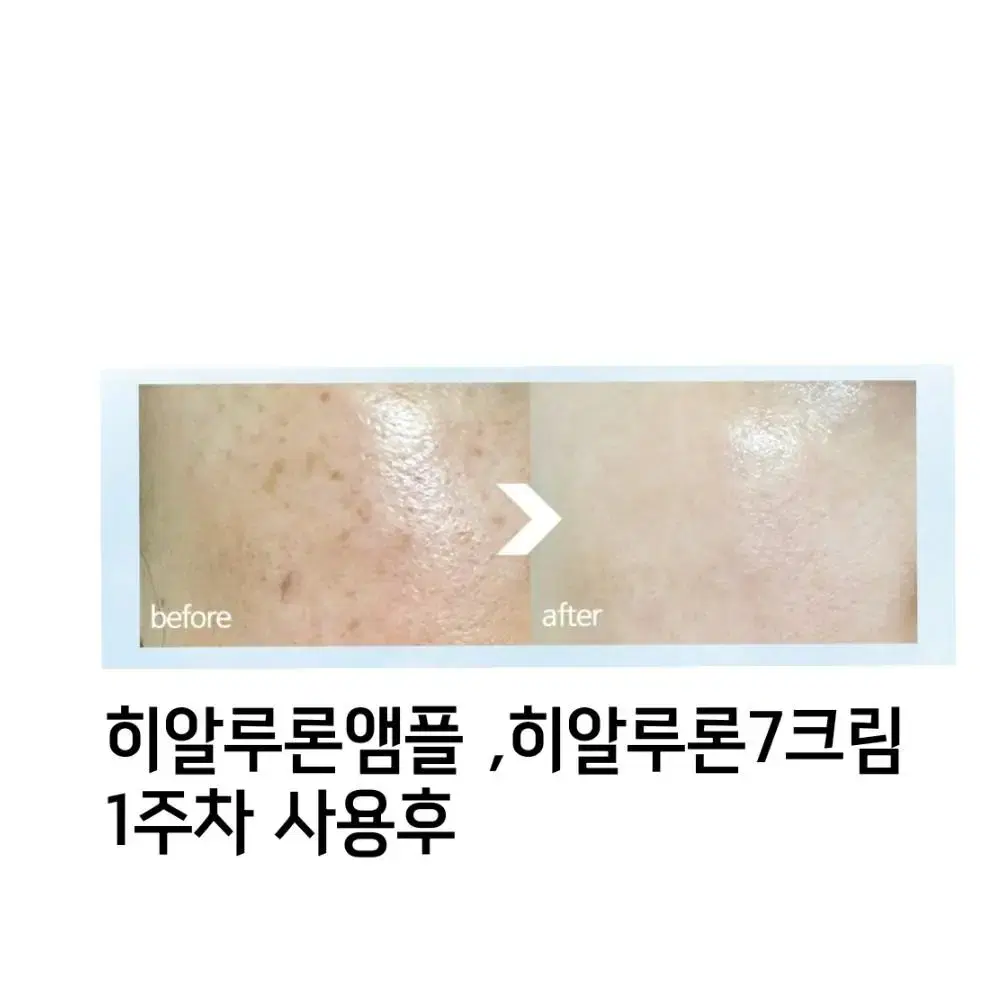 100%효과보장 토닝 레이저 필요X , 기미 주근깨 잡티 미백 기미 크림