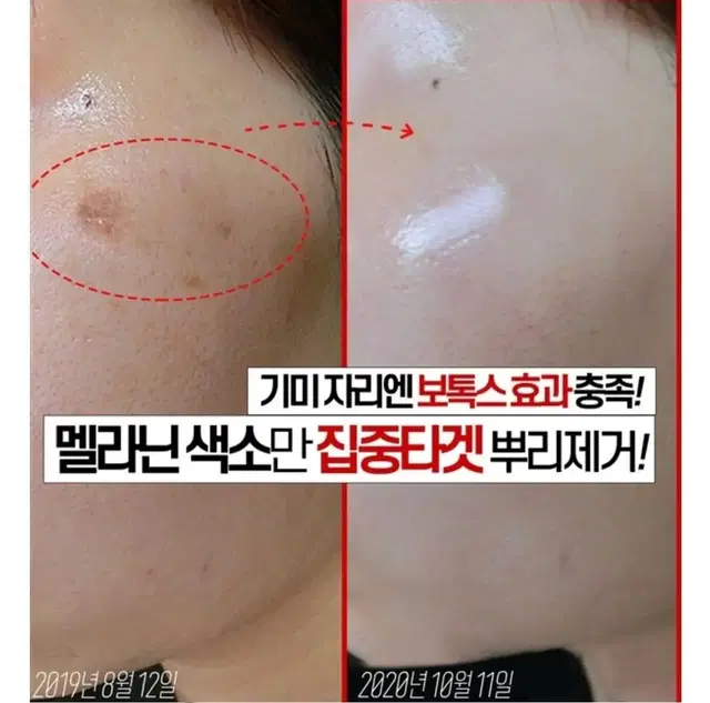 최초특허 피부세포침투단1회 사용으로 눈밑꺼짐 팔자주름 개선 바르는 보톡스