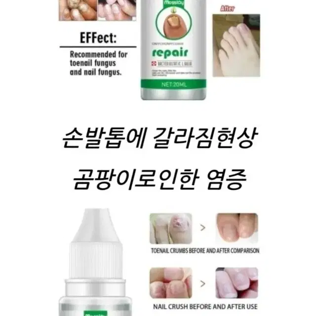 2일배송 발톱 무좀 치료 발톱 무좀 연고 진균제 손톱 염증 약