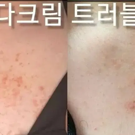 아픈피부엔 다덴다! 홍조, 아토피, 건선피부에도 ok! 다덴다크림겔