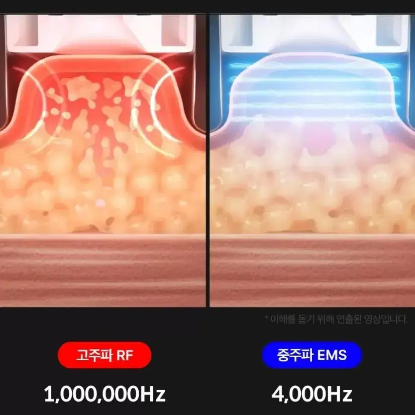 메디큐브 바디 석션샷