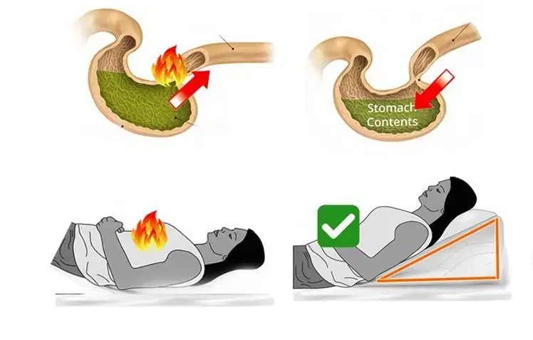 역류성식도염 베개 휴대용 접이식 군대 배게 다리 올리는 쿠션 부종 예방
