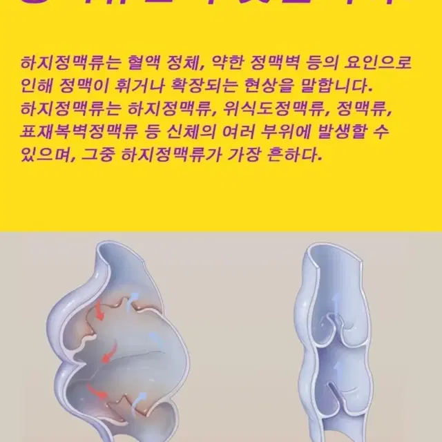 하지정맥류크림  2개