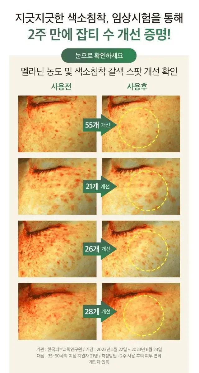 2주만에 색소침착 주근깨 기미 잡티 감소 피부자극없는 멜라토닝 미백 앰플