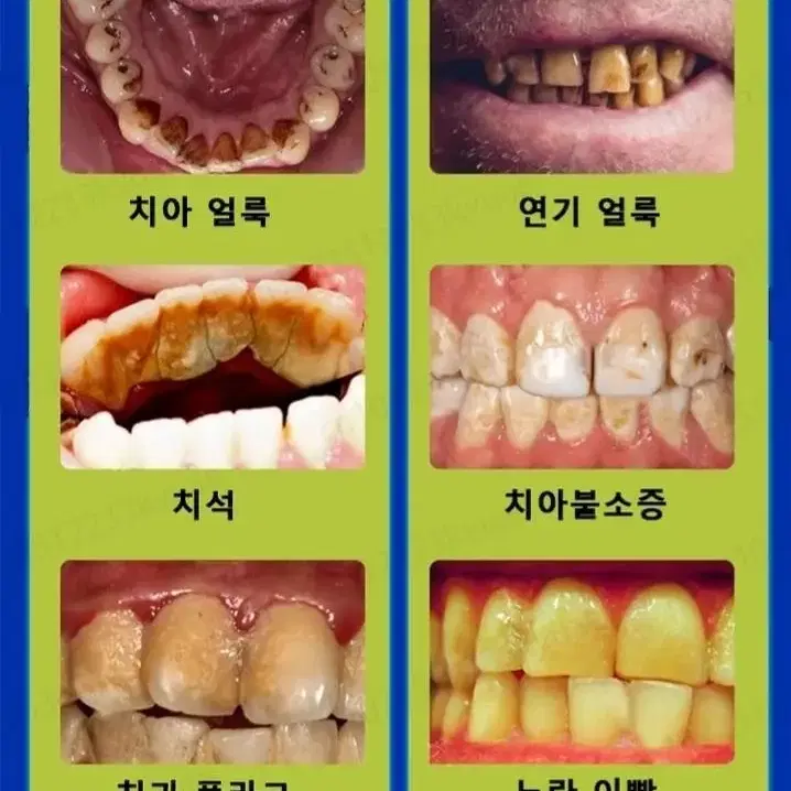 천연 미백치약 누런이 치석 미백치약 치아미백 누런이 화이트닝 입냄새제거