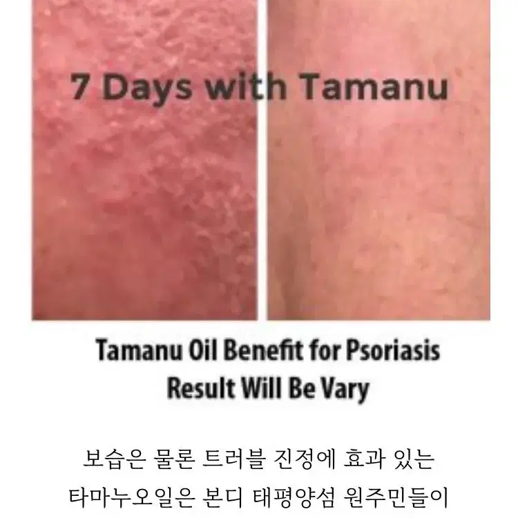 타마누 오일 (Tamanu oil)